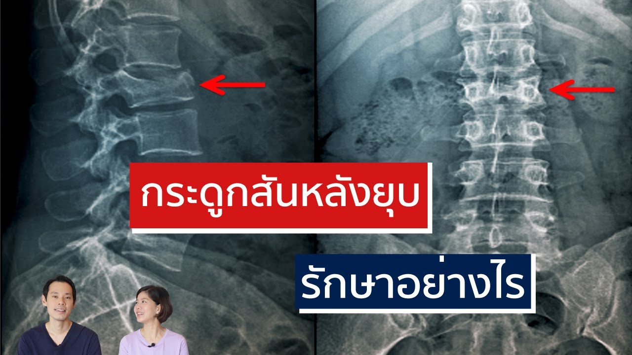 กระดูกสันหลังหักยุบในคนสูงอายุ รักษาอย่างไร | EasyDoc EP.22