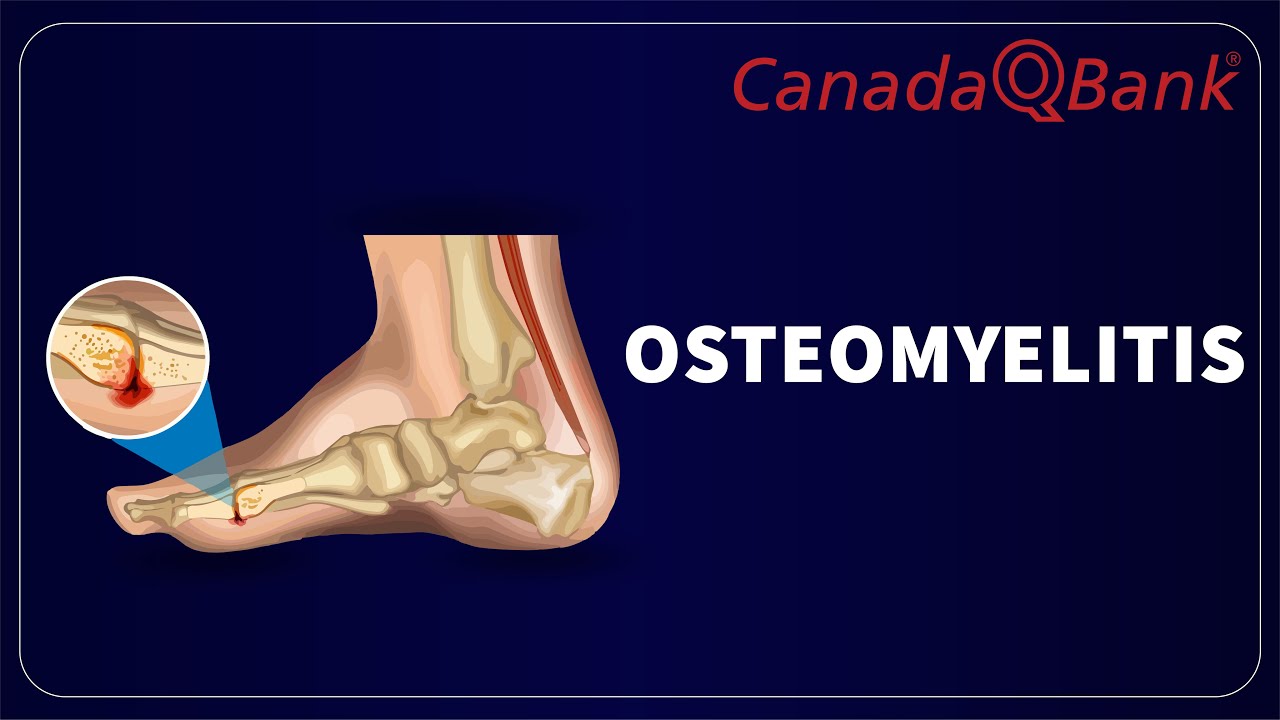 Osteomyelitis: Symptoms, Diagnosis & Treatment | Clinical Cases | CanadaQBank