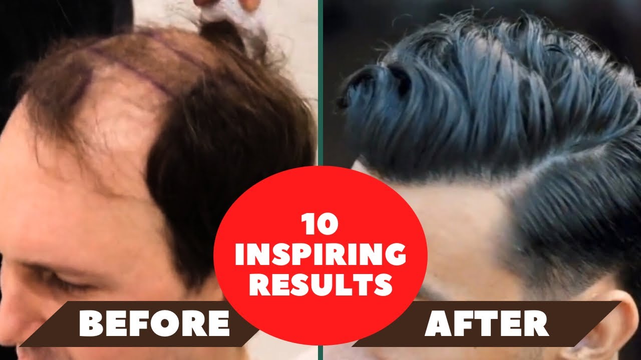 10 Inspiring Hair Transplant Results (Before & After)