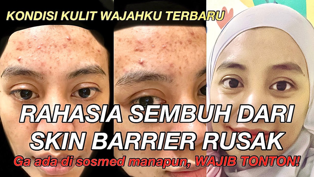 RAHASIA SEMBUH DARI SKIN BARRIER YANG RUSAK. (My Skin Journey part 3)