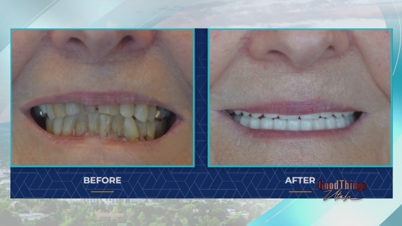 ClearChoice Dental producing amazing dental implant makeover results