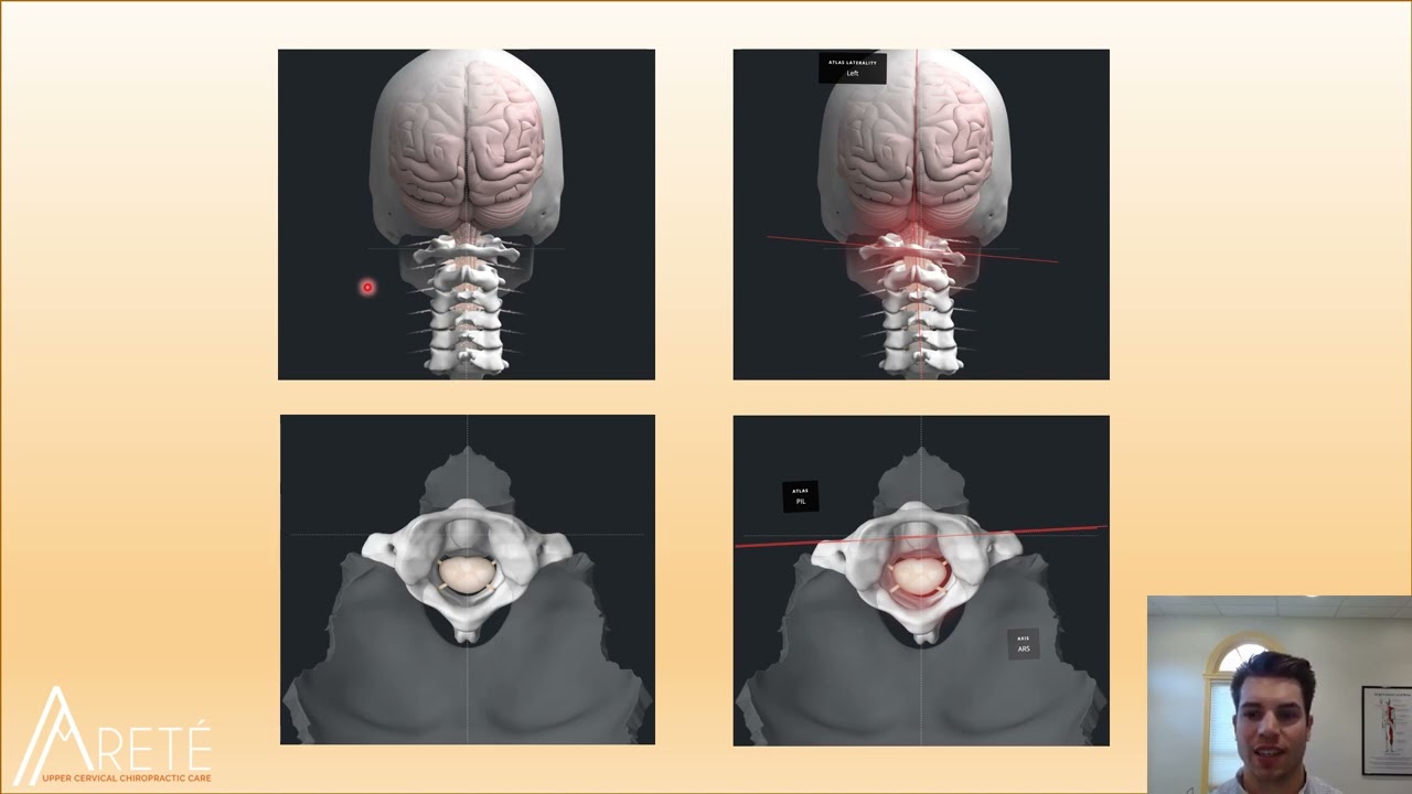 Concussion & Whiplash • Upper Cervical Chiropractic Care