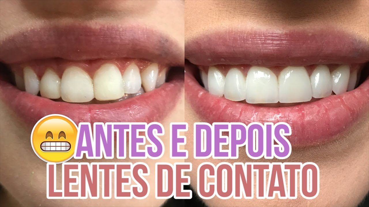 MUDEI MEU SORRISO - LENTES DE CONTATO NOS DENTES