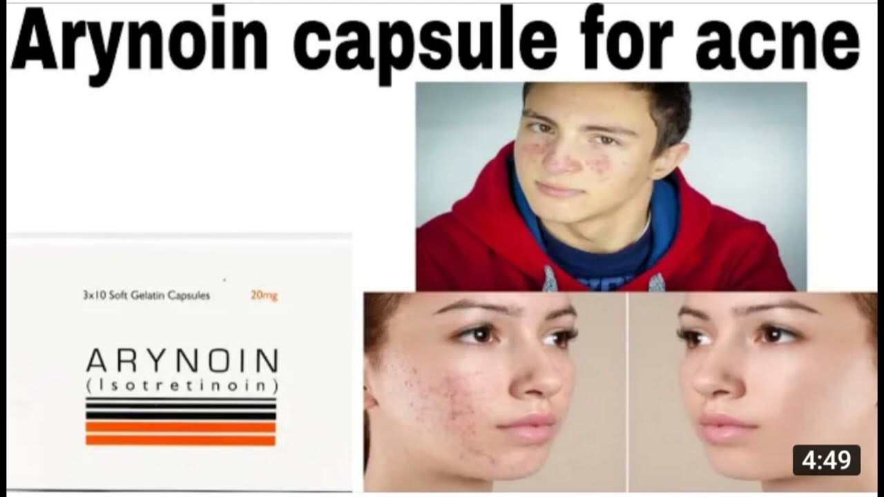 Cap Arynion 20mg(Isotretion)Uses in urdu Ansar noor medical media)Arynion used for Acnes&pimples