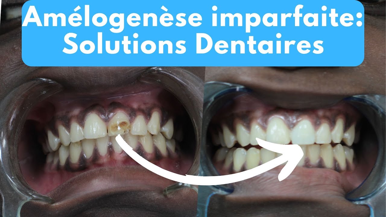 Amélogenèse Imparfaite : Causes, Symptômes et Solutions Dentaires