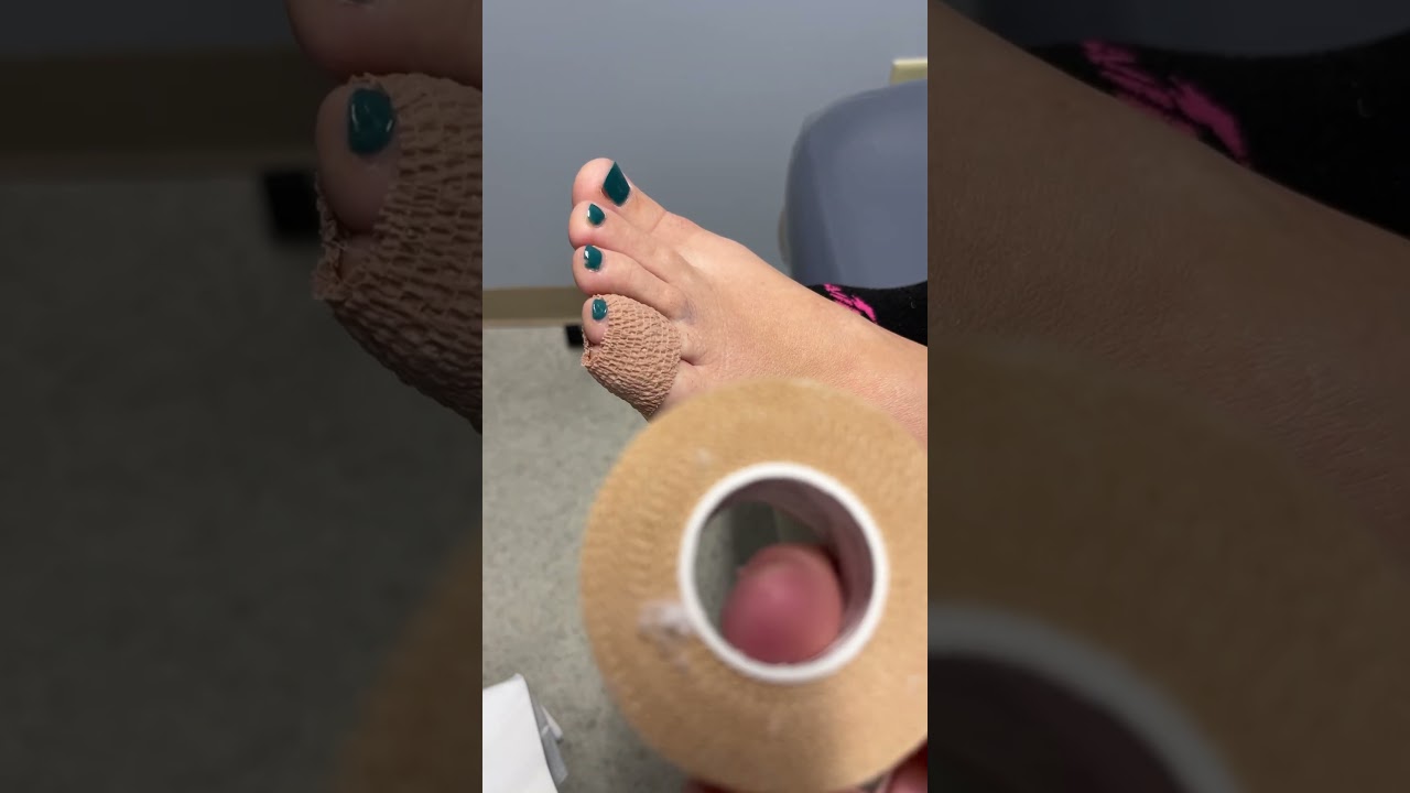 Что лучше: пластырь или кобан при переломе пальца ноги?