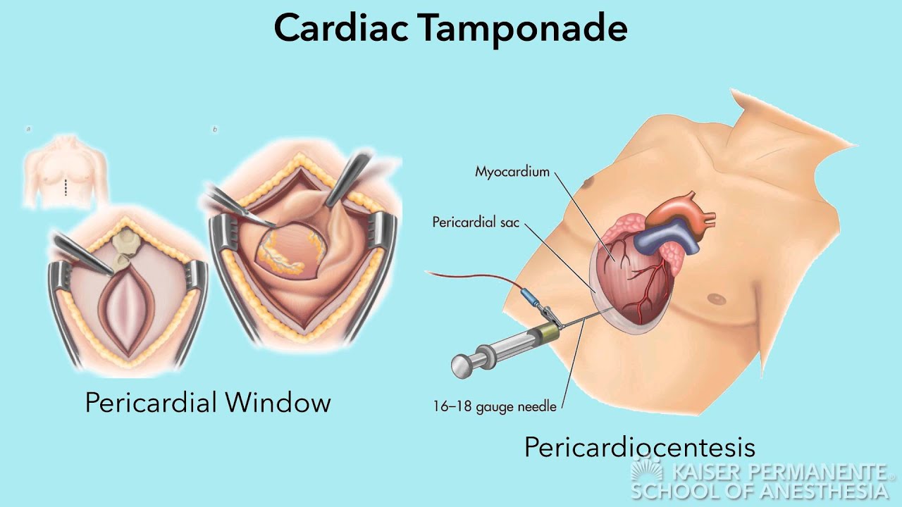 Cardiac Tamponade - Education