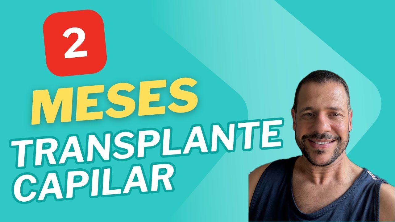 Minha Evolução com 2 Meses de Transplante Capilar. Já Dá Pra Ver Resultado com 2 Meses?