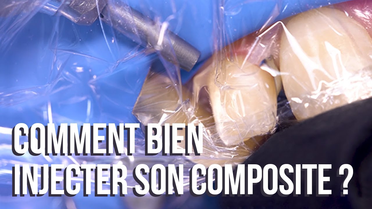 🦷 Restauration par composite injecté - Partie #2