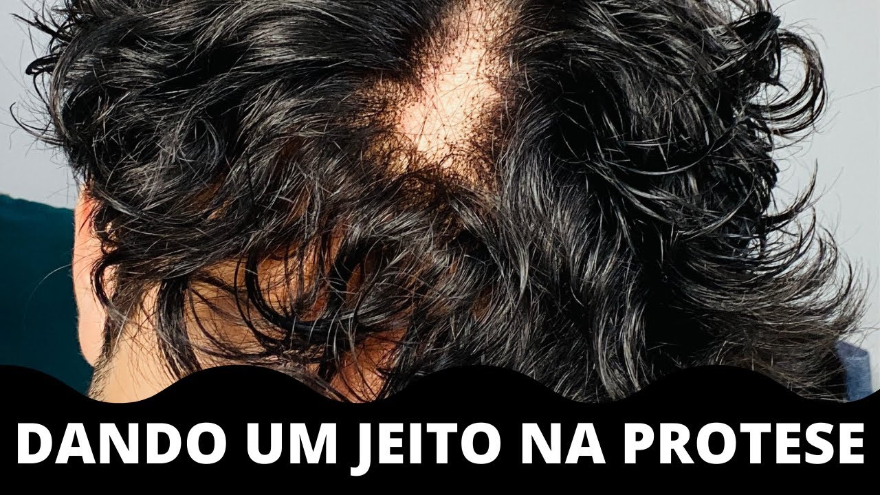 DICA: CAIU CABELO DA PROTESE, E AGORA???  |#PROTESECAPILARMASCULINA|@JADSON.ANDRESEN