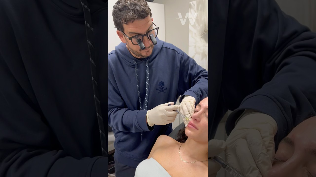 Restylane Kysse Lip Filler before and after results with Dr. Wise in Wayne, NJ for a plumper pout