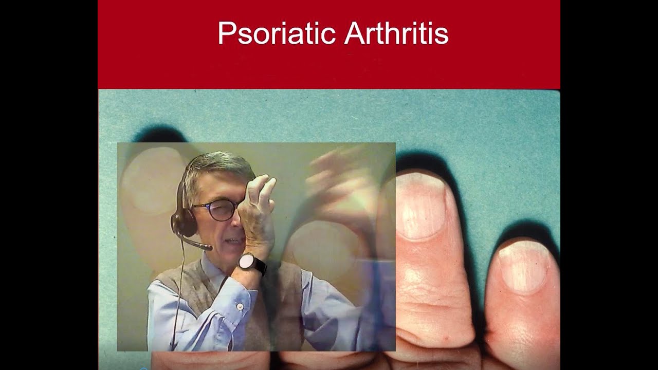 8 Psoriatic Arthritis