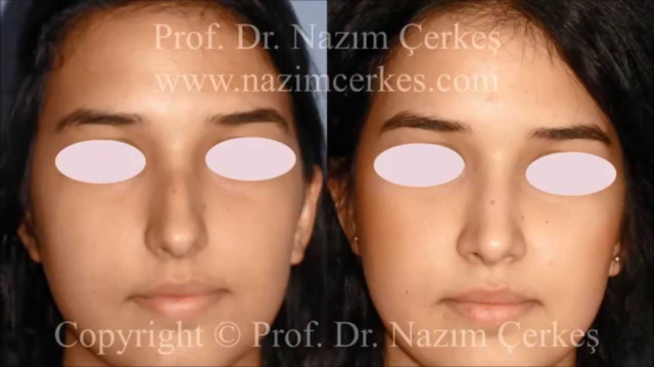 BURUN ESTETİĞİ FOTOĞRAFLARI BAYAN HASTALAR | PROF DR NAZIM ÇERKEŞ