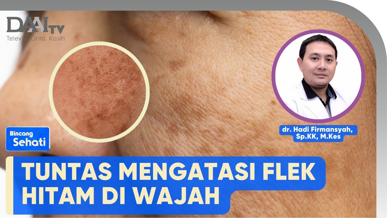 Tuntas Mengatasi Flek Hitam | Bincang Sehati