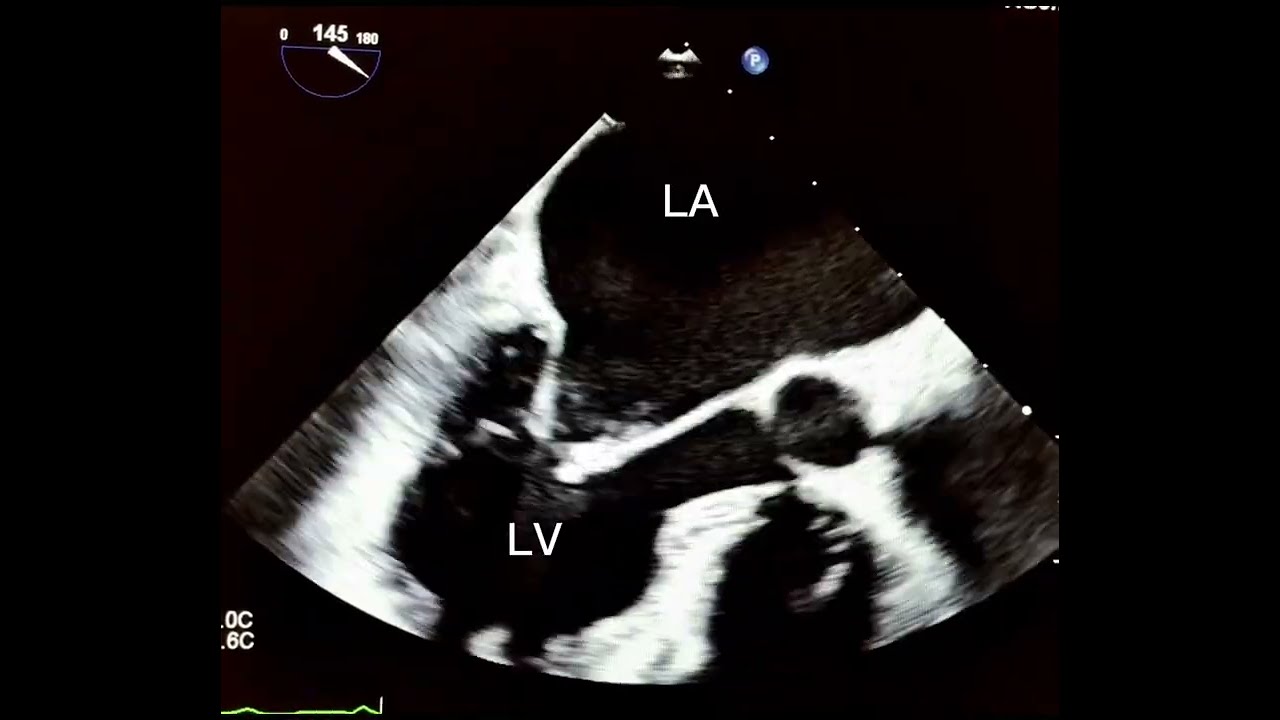 Large Left Atrial Thrombus Despite Sinus Rhythm , Is Sinus Rhythm Truly Protective?”