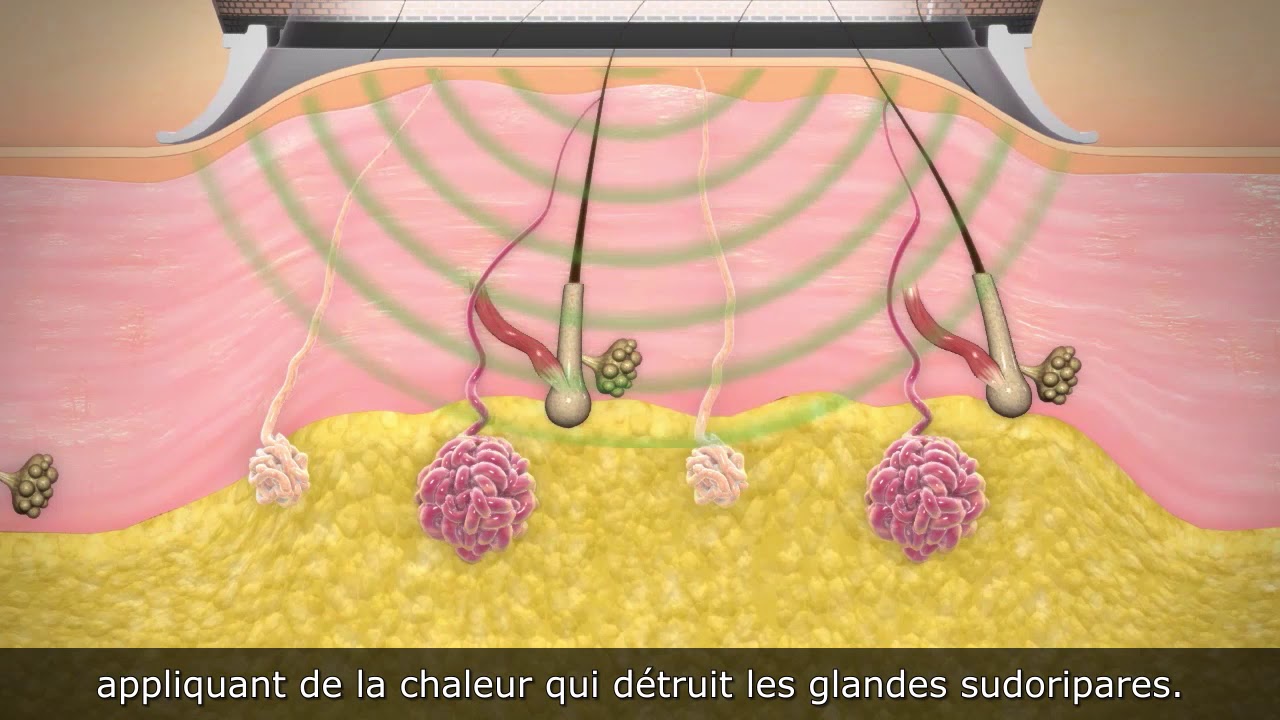 miraDry hyperhidrose, solution anti transpiration des aisselles à Bordeaux