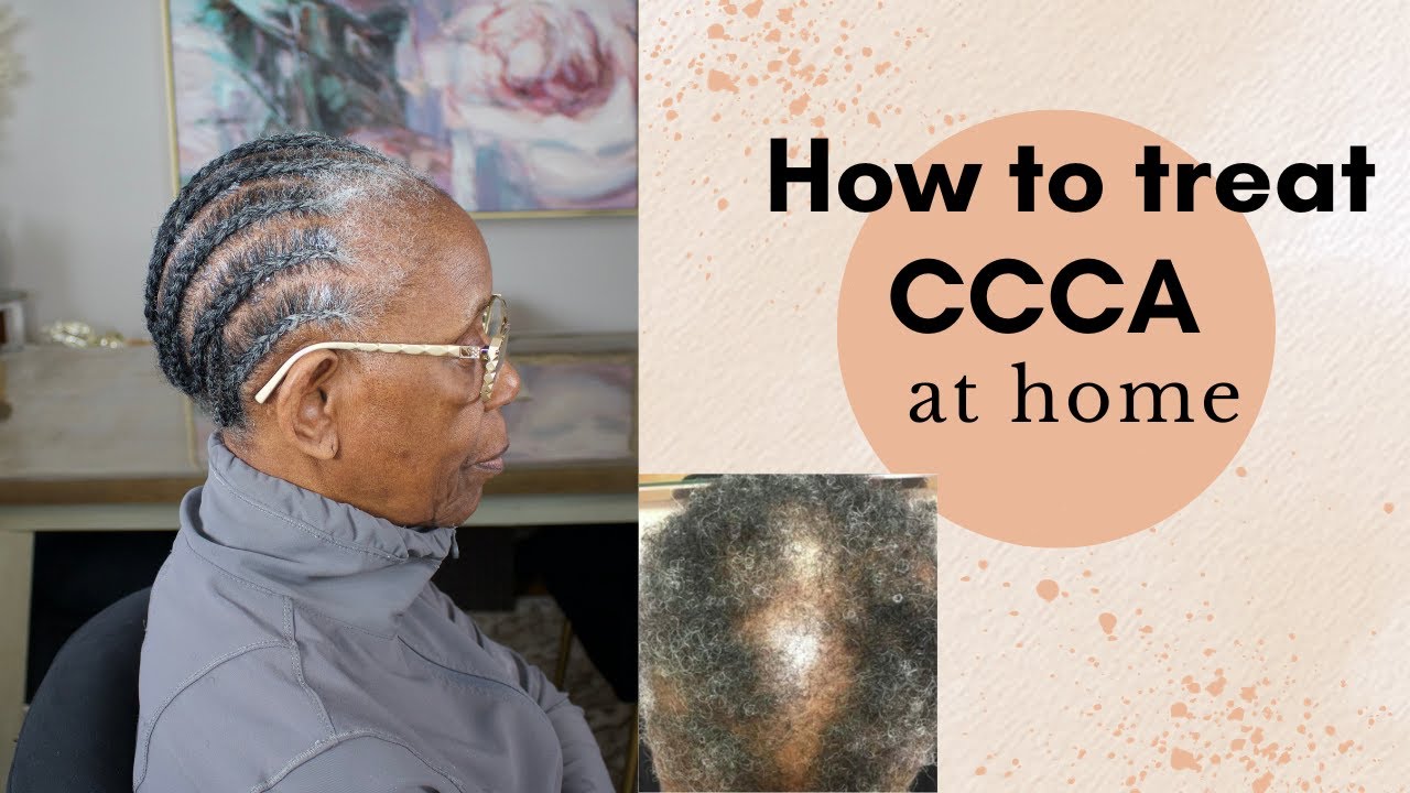 Alopecia| How to treat CCCA at home