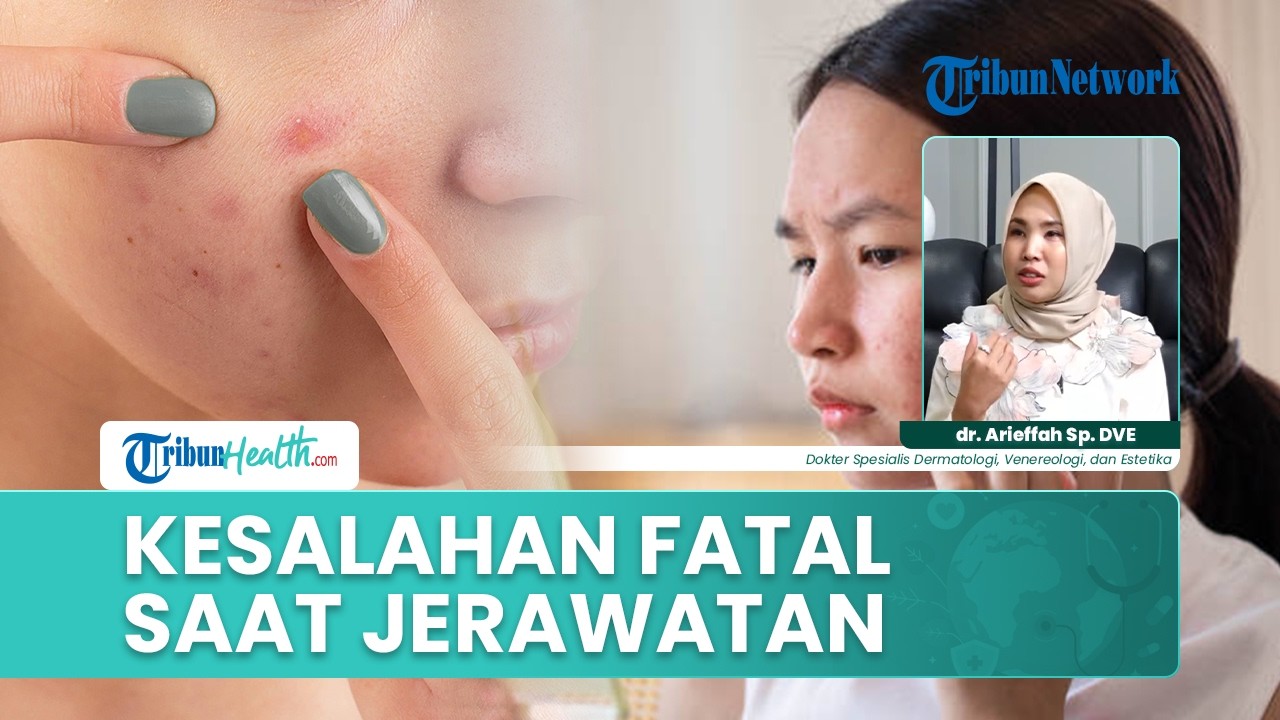 Kesalahan yang Paling Sering Dilakukan Saat Mengobati Jerawat dan Dampaknya pada Kulit