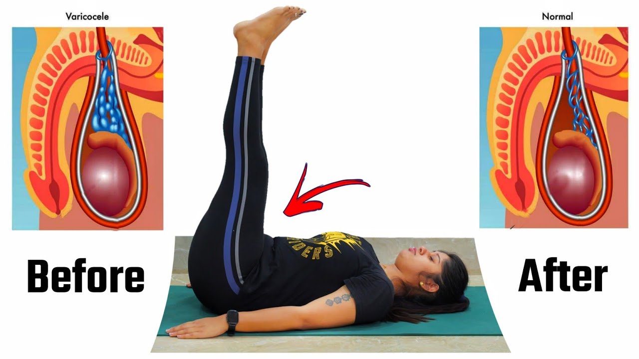 यह एक्सरसाइज वैरीकोसेल की समस्या जड़ से खत्म कर देगी | Yoga Exercise for Varicocele | @Yogawale