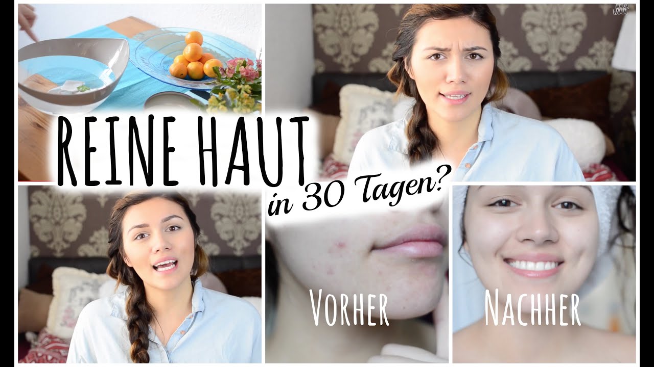 REINE HAUT in 30 Tagen? (Vorher/Nachher) #BetterSkinwithAnna