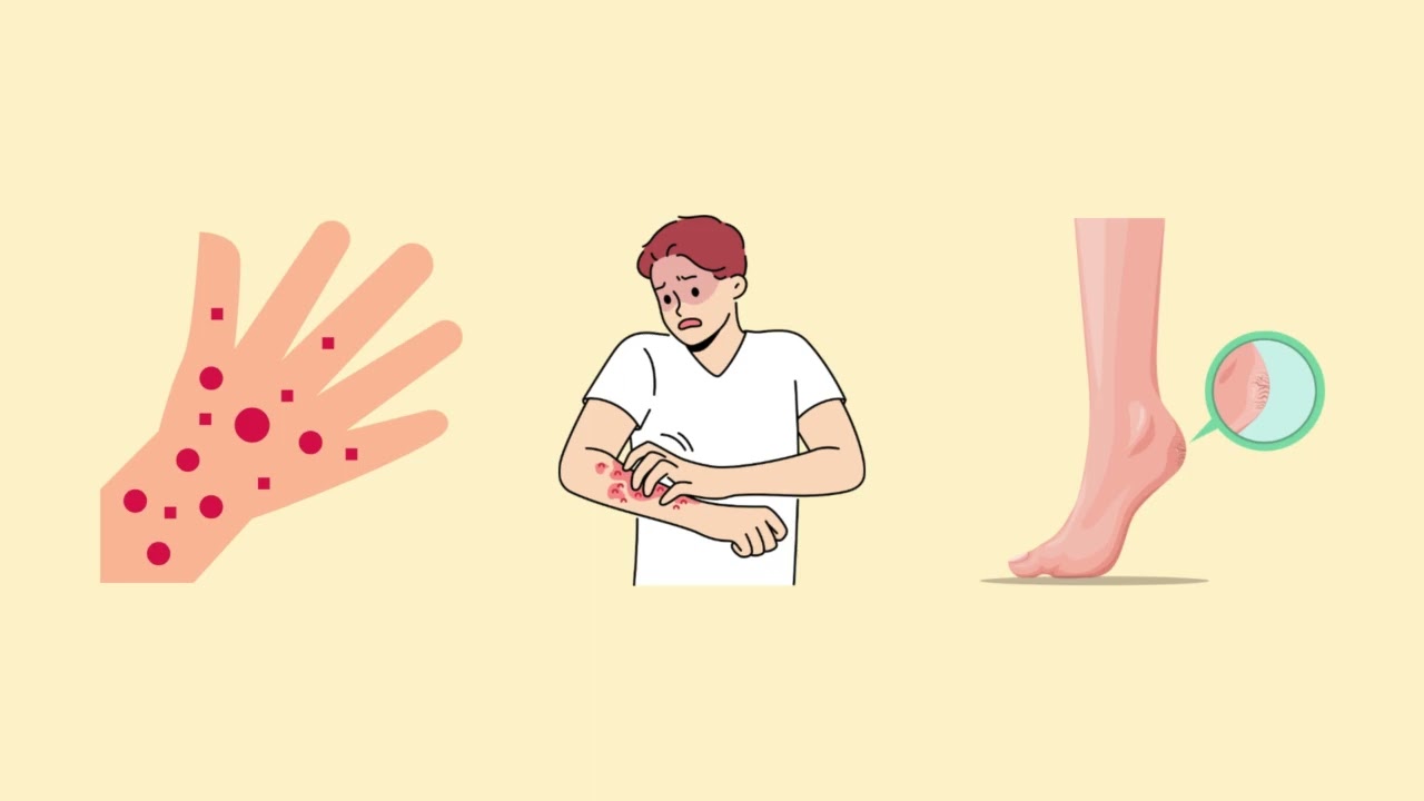 Dermatitis Kontak Iritan? Gampang ketauan! Gampang pencegahan!