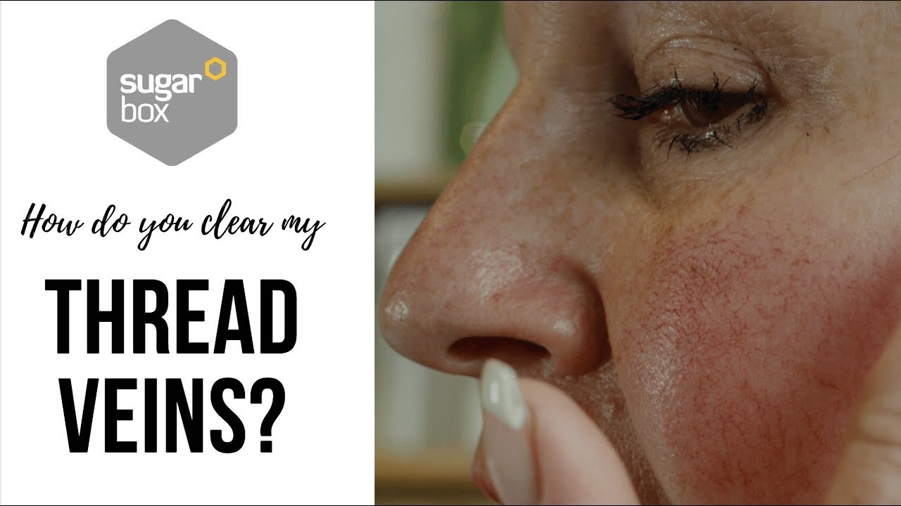 Ann's Facial Thread Vein Removal Journey - Episode 1 - Test Patch