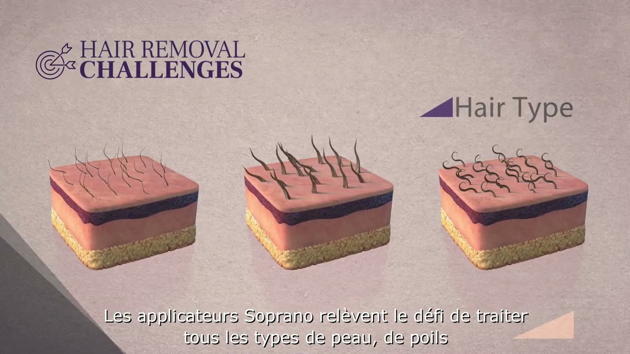 Epilation laser définitive - Soprano Titanium® - Clinique Clemenceau Lille et Arras