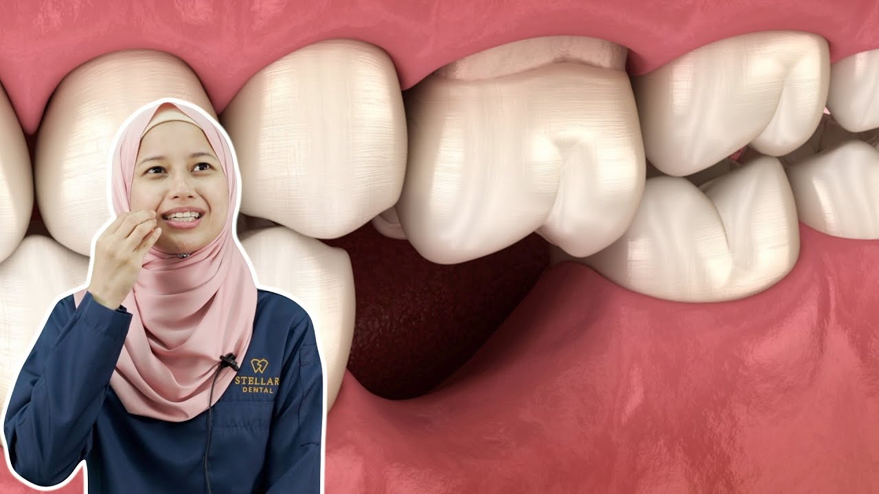 Ini Kesan Jika Anda Tak Ganti Gigi Kekal yang Dicabut