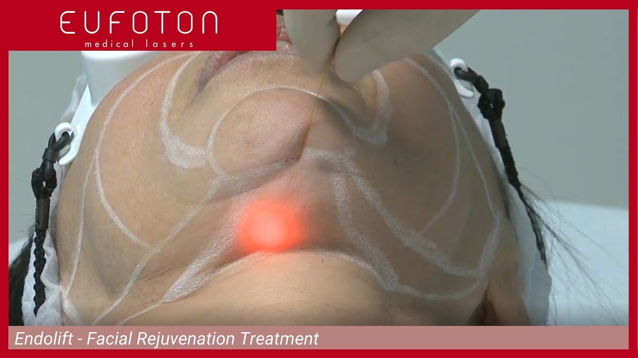 Laser Facial Rejuvenation Treatment - Aesthetics | Ringiovanimento Viso – Endolift® [Eufoton®]