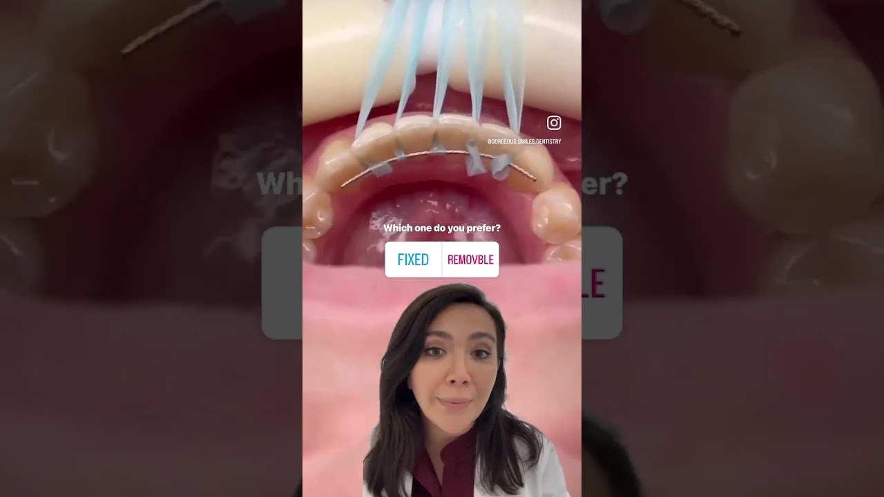 Which Is Better for Your Teeth? Fixed Retainer or Removable?