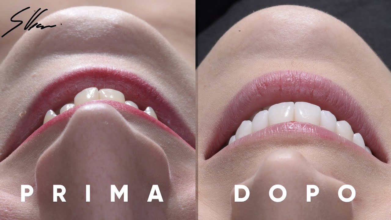 Come e quando riallineare i denti con le faccette dentali e senza apparecchio