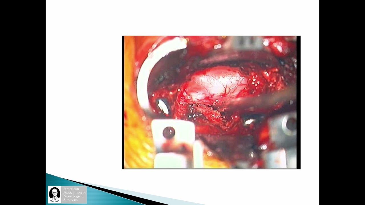 AANS Coding Shorts: Introduction of the 63052 and 63053