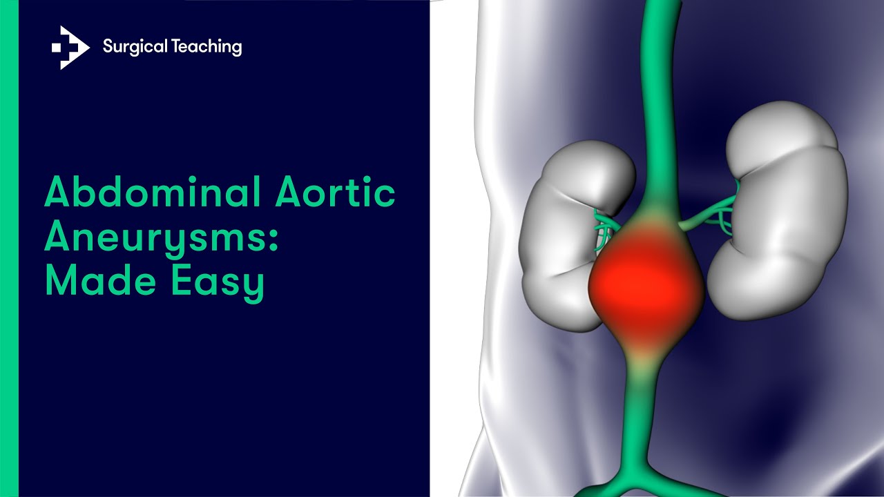 Aortic Aneurysms | All you need to know for med school