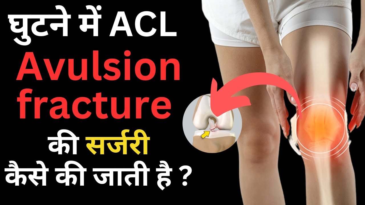 घुटने में ACL Avulsion fracture की सर्जरी कैसे की जाती है ? #avulsionfracture #drmanubora