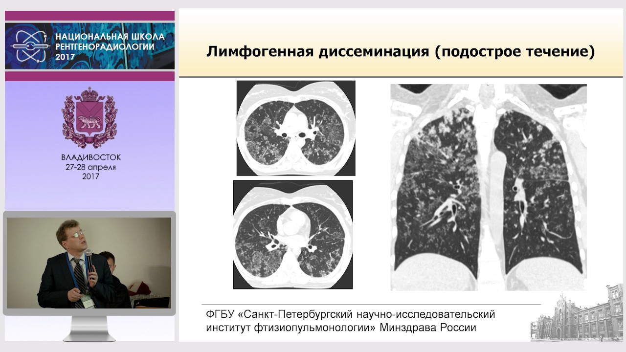 П.В. Гаврилов - Диссеминированный туберкулез легких: скиалогическая картина