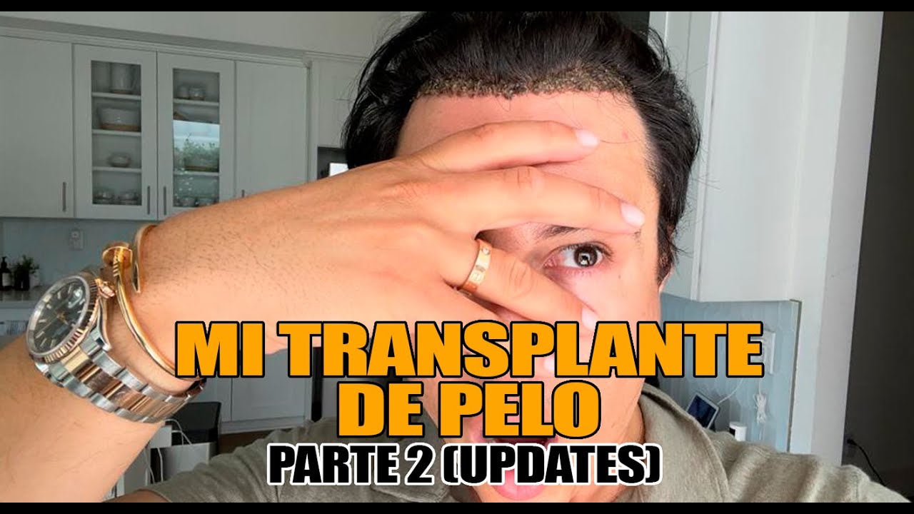 Progreso de Mi Transplante De Pelo, Hay Dolor!!  Quedo Feo?  | Yasmany