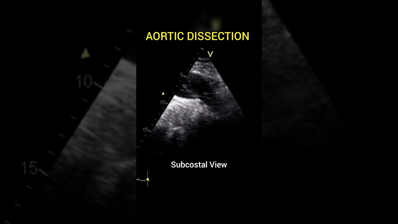 Aortic Dissection with freeflow between True and False Lumen #echocardiography