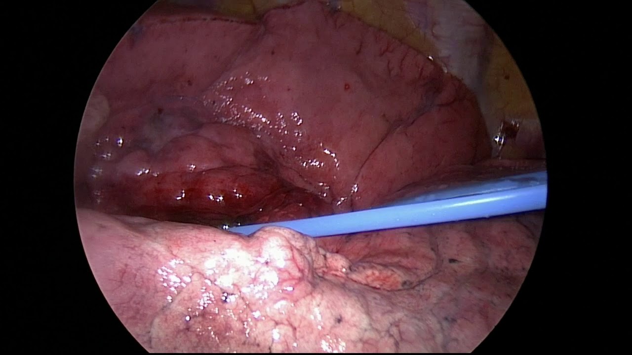 VATS-лобэктомия средней доли правого легкого