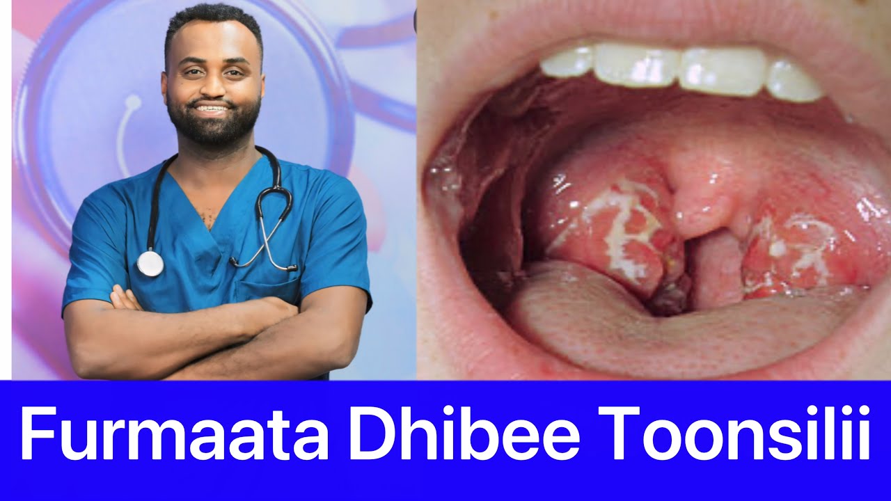 Dhibee Toonsilii akkamitti manatti of yaalla?