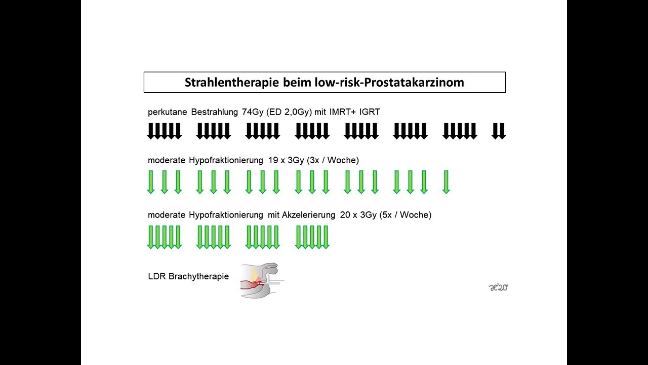 Strahlentherapie beim low-risk-Prostatakarzinom | Strahlentherapie Prof. Hilke Vorwerk