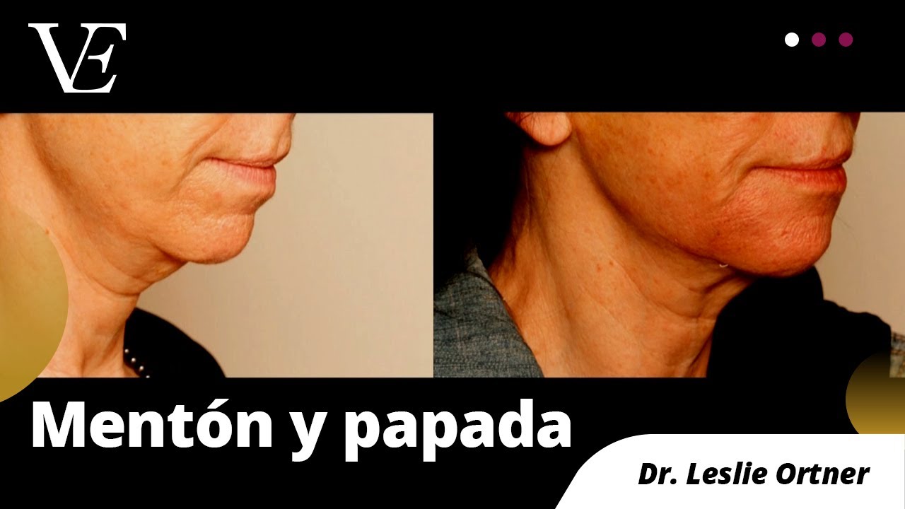 RETRACCIÓN DE MENTÓN Y PAPADA