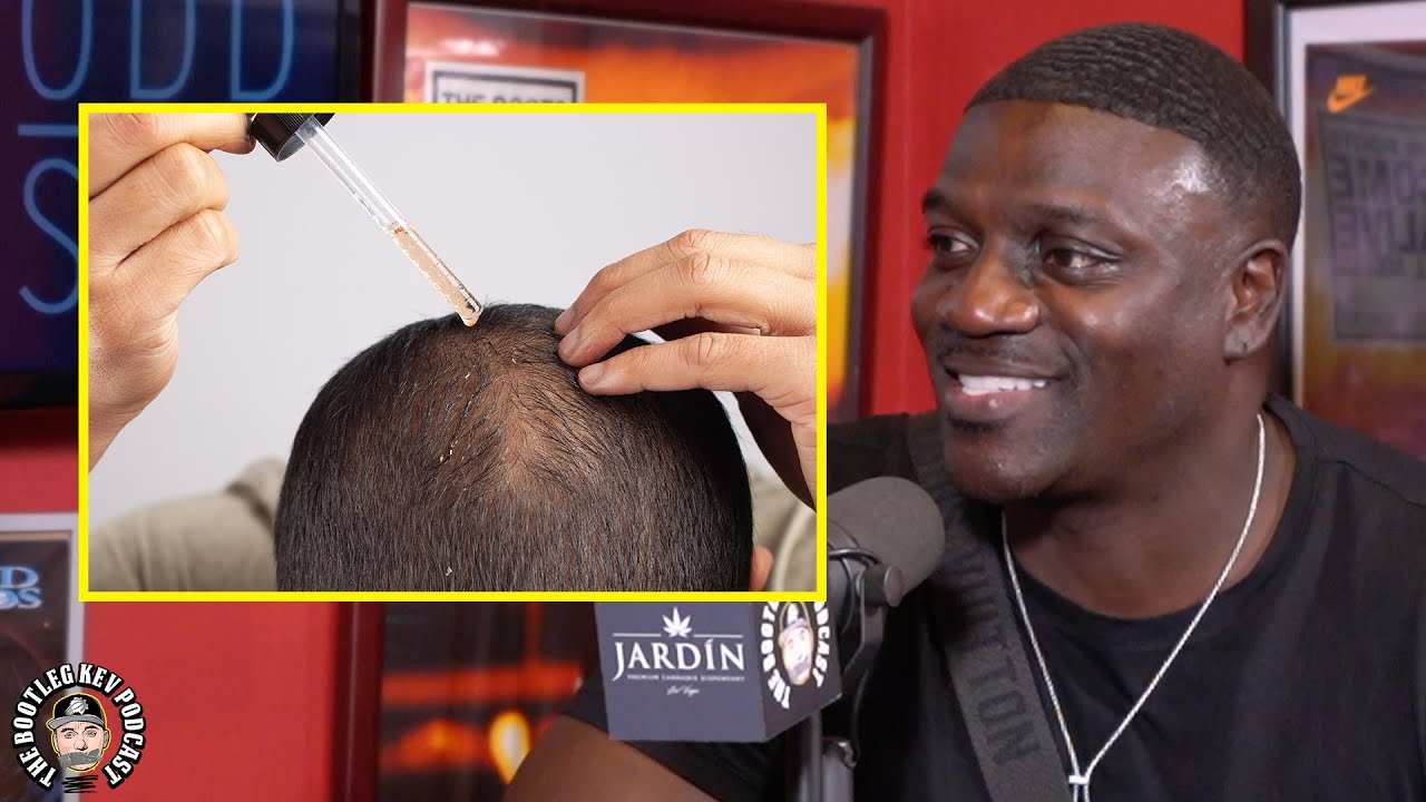 Akon on Getting Hair Transplant, He Told Tory Lanez Go To His Doctor