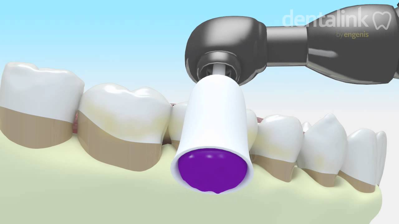LIMPIEZA periodontal supragingival [Sarro dental] - Video 3D