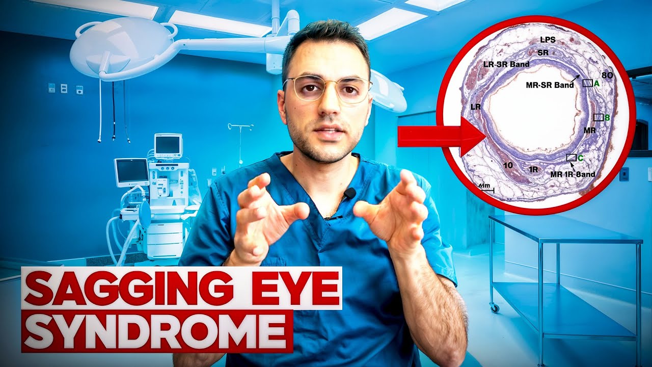 Sagging Eye Syndrome: A Common Cause of Double Vision in Older Adults