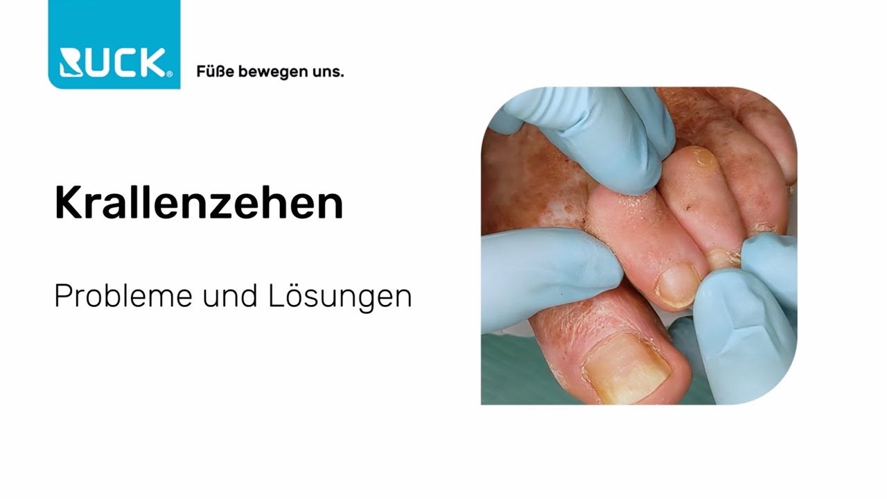 Krallenzehen | Behandlung, Druckentlastung & Übungen