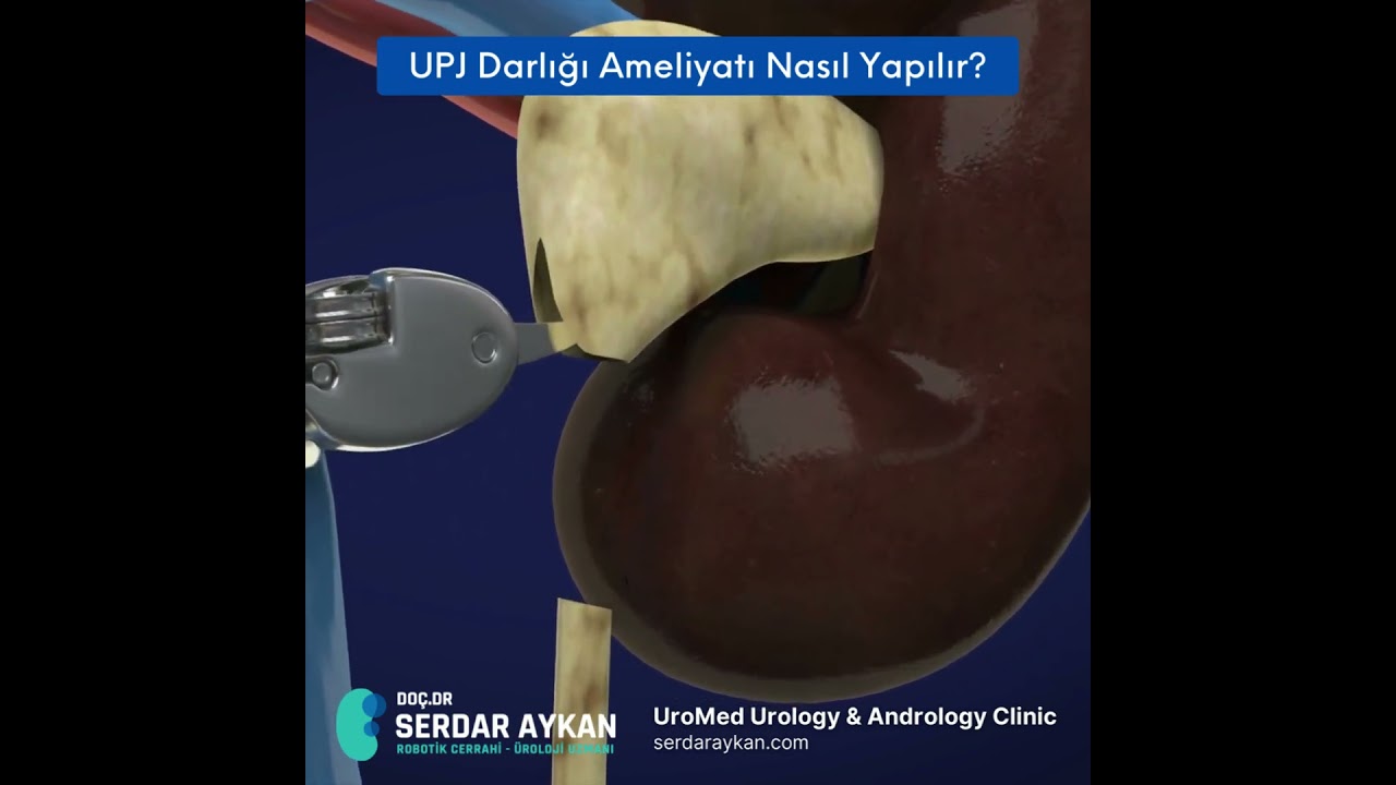 PYELOPLASTY, LAPAROSKOPİK ROBOTİK PİYELOPLASTİ. DO&Ccedil; DR SERDAR AYKAN