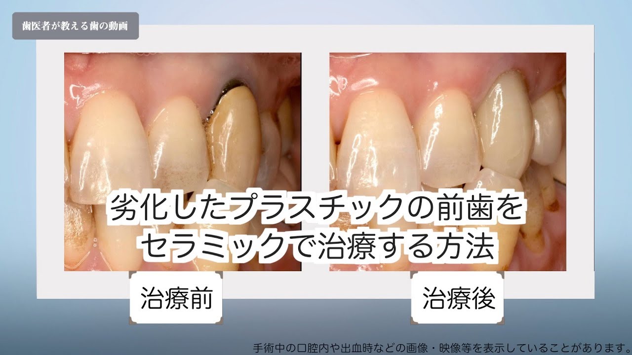 劣化したプラスチックの差し歯をセラミックで治療する方法