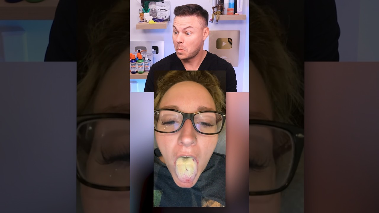 The Most Disgusting Mouth Disease In The World?!