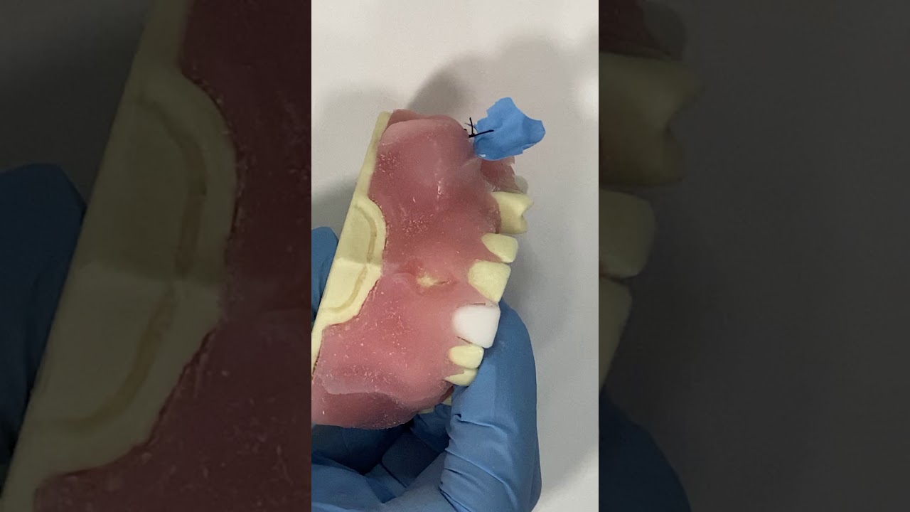 Practica de Frenectomía labial superior