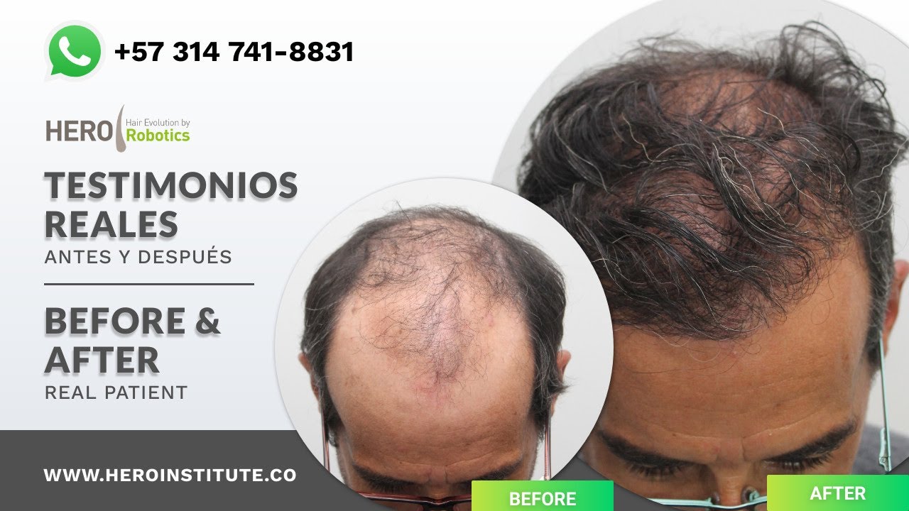 Trasplante de Cabello | ¿Realmente vale la pena? | ¿Es la solución definitiva para la calvicie?